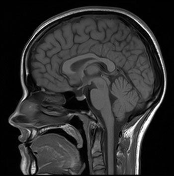 Image d'un cerveau d'une IRM